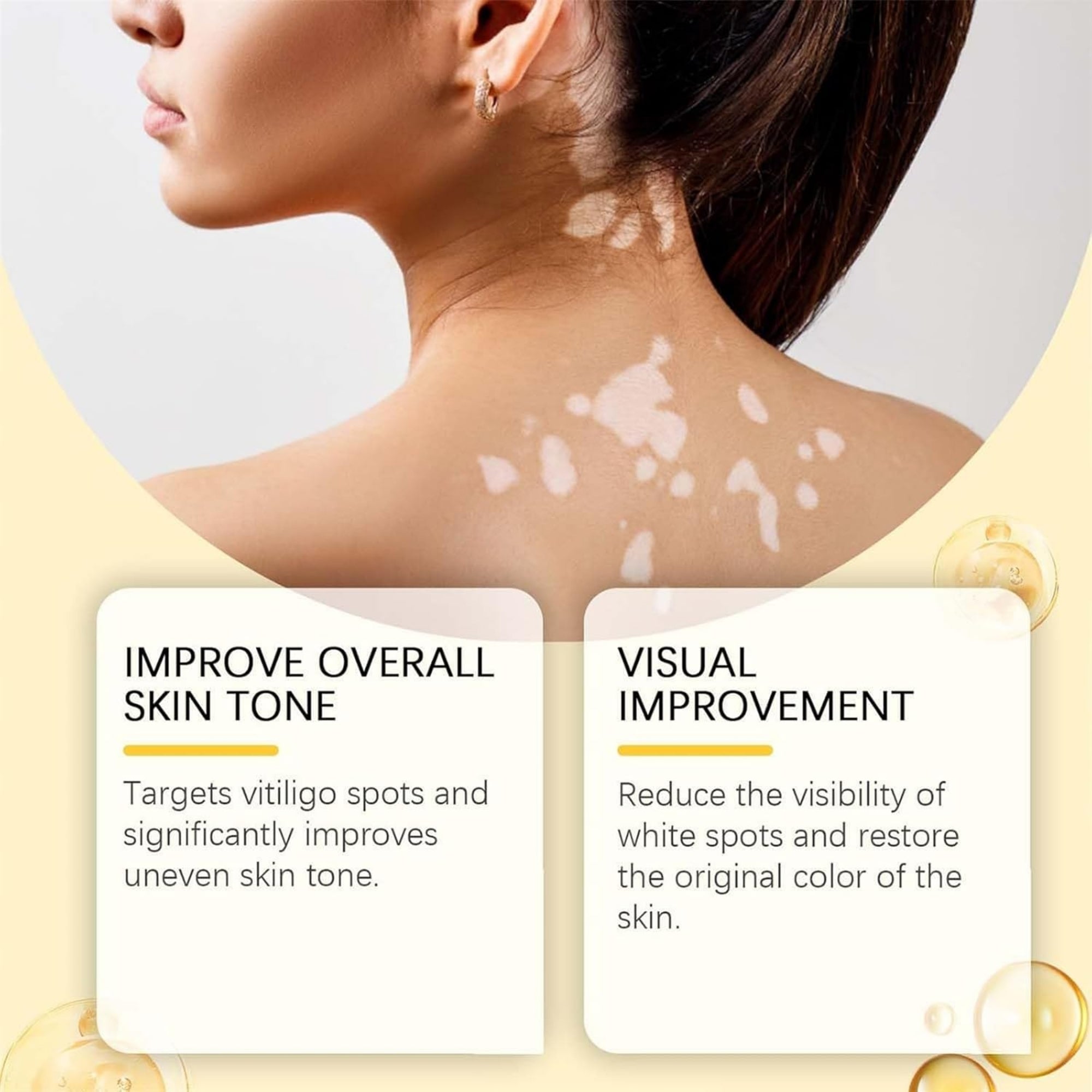 Vitigo Bee Venom Treatment Cream | Natural Skin Repair Hydration Relief Anti-Irritation - Essence Trove