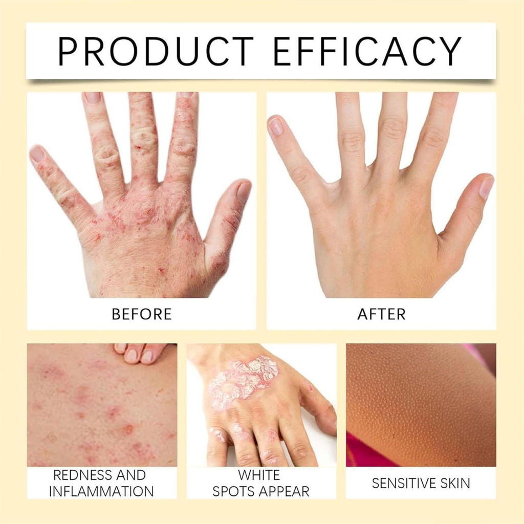 Vitigo Bee Venom Treatment Cream | Natural Skin Repair Hydration Relief Anti-Irritation - Essence Trove