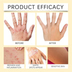 Vitigo Bee Venom Treatment Cream | Natural Skin Repair Hydration Relief Anti-Irritation - Essence Trove