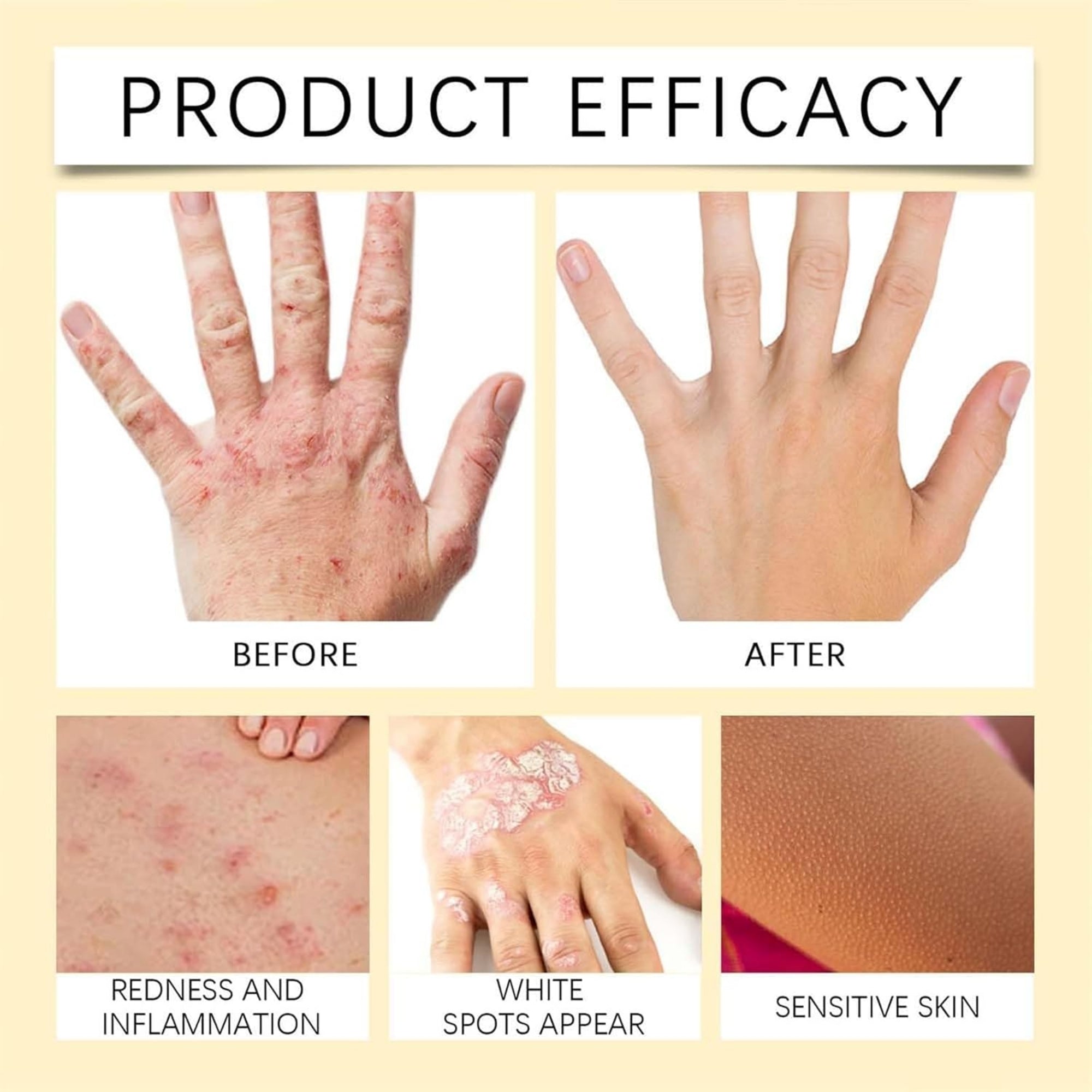 Vitigo Bee Venom Treatment Cream | Natural Skin Repair Hydration Relief Anti-Irritation - Essence Trove